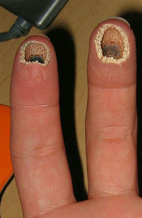 空手指和莲蓬乳是什么病(莲蓬乳和空手指图片)