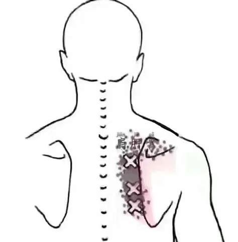 肩背疼痛什么原因引起的(颈椎右肩膀疼痛的可能疾病)